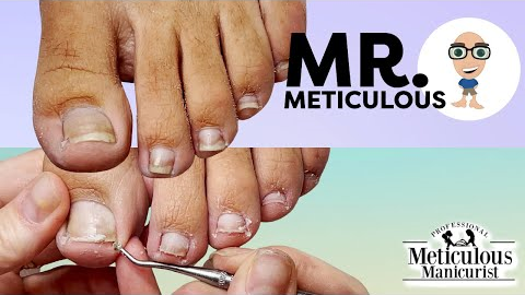 👣Mr. Meticulous Pedicure Tutorial Impacted Big Toenails with ASMR👣