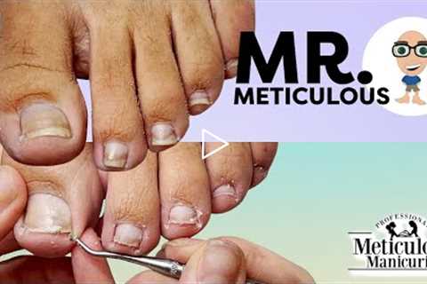 👣Mr. Meticulous Pedicure Tutorial Impacted Big Toenails with ASMR👣