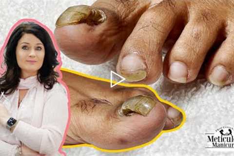 👣Tutorial on How to Care & Treat a Detached Big Toenail with a Pedicure👣