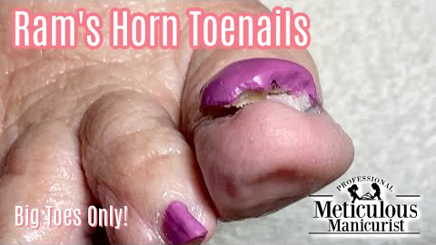 👣Big Toes Only - Pedicure How to on Impacted Ram's Horn Toenails - RIGHT FOOT👣