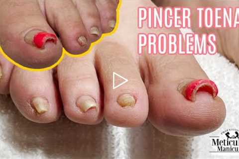 👣Pedicure Tutorial on Big Pincer Toenails that Cause Pain👣