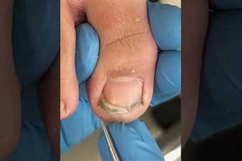 Dirty toenails, clean！#pedicure #ingrown_toenail