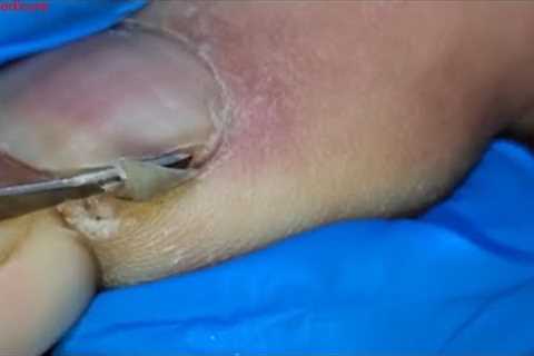 Pedicure tutorial: Very thick toenail being trimmed