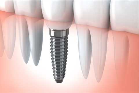 What to Expect During and After Dental Implant Surgery