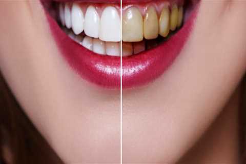 Effective Teeth Whitening Techniques for a Brighter Smile
