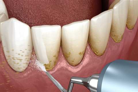 Tips for Maintaining Healthy Gums and Preventing Gum Disease