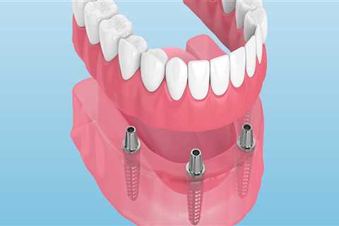 Implant Innovations: Advancements in Dental Restoration Technology