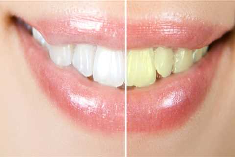 What is Cosmetic vs Esthetic Dentistry