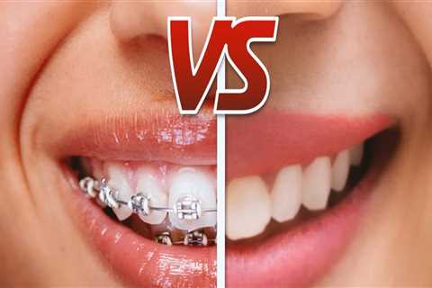 Which is Easier Braces or Invisalign