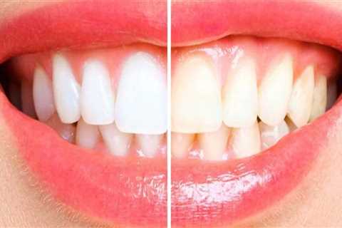 What Home Remedy Whitens Your Teeth