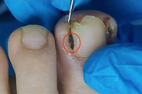 【Daily Pedicure Tutorial】Removing Deeply Embedded Ingrown Toenails on Both Sides of The Big Toe