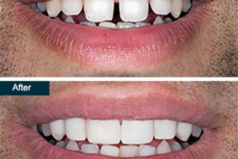 Is Cosmetic Teeth Bonding Safe