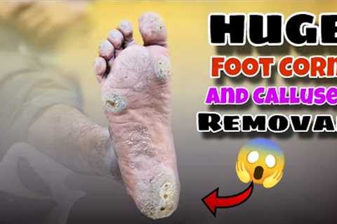 pedicure: Huge Foot Corn Removal and Feel Relaxing!! Foot Calluses Removed !!