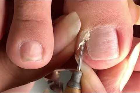 Clean the Skin and remove the corner of the nail#481