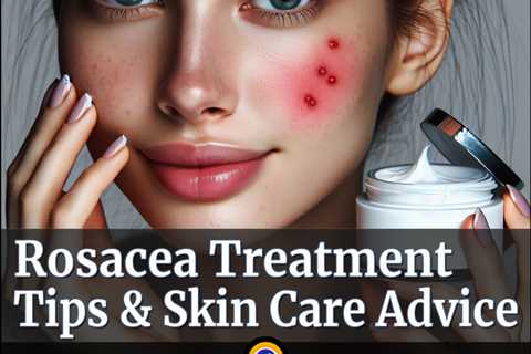 Rosacea Treatment Tips & Skin Care Advice